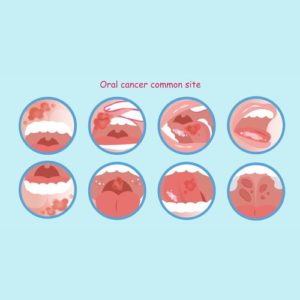 Icons showing the signs of oral cancer