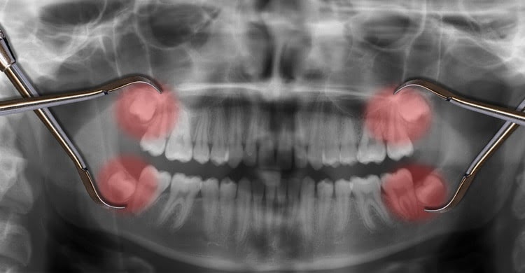 Do Wisdom Teeth Have to be Removed?