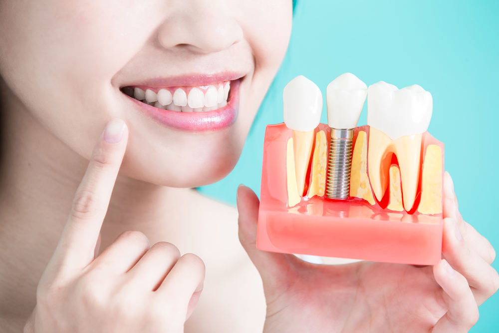 Dental Implants: 6 Things You Need To Know