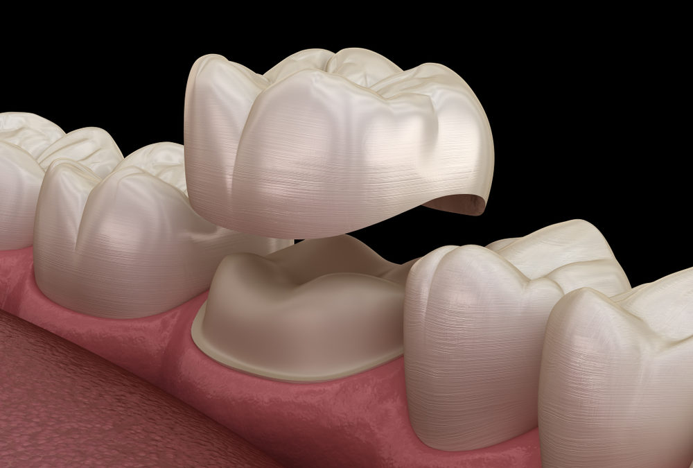 Dental Crowns – SAME DAY!