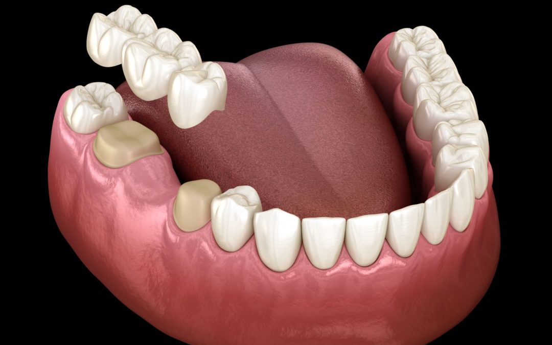 Dental Bridge: Types, Benefits, Cost